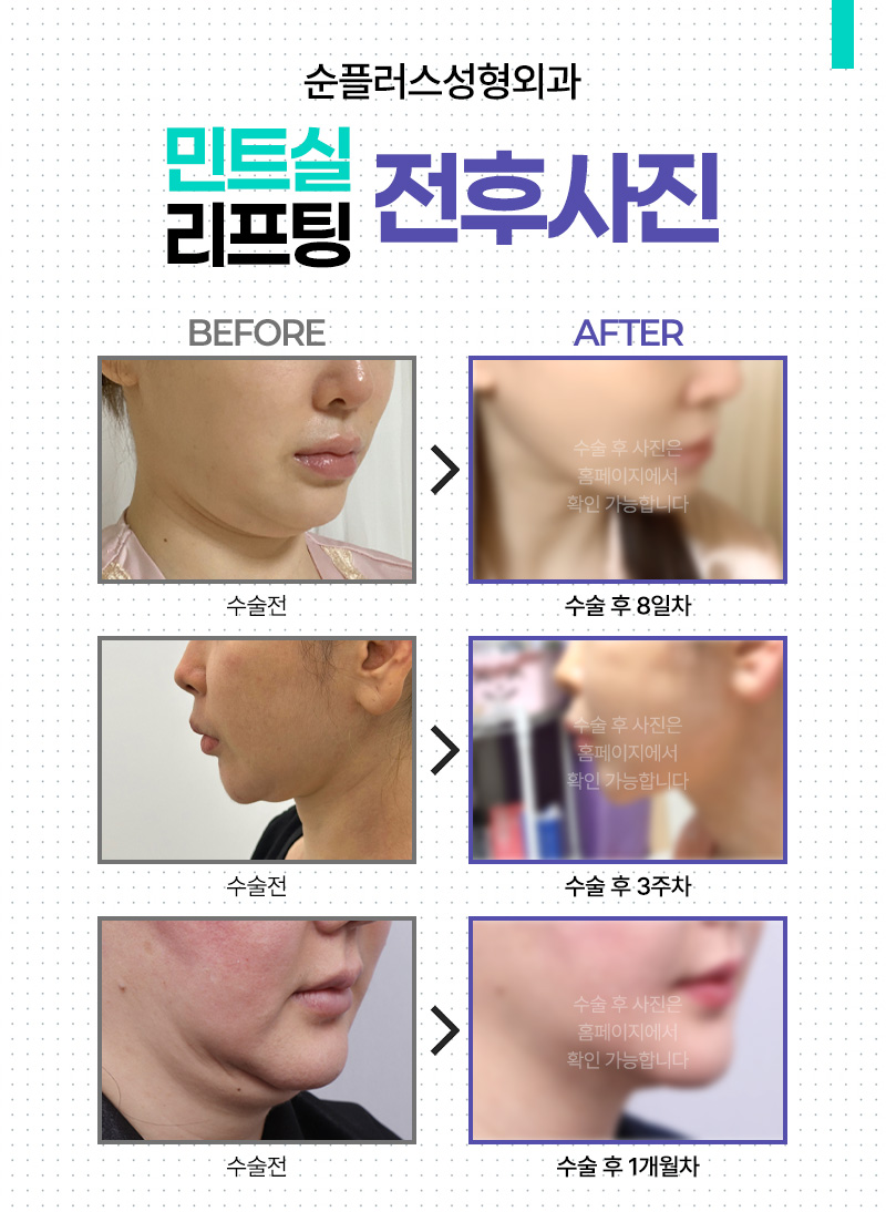 민트실리프팅 효과, 처진 볼살과 무너진 턱선에 도움이 될까? 관련 이미지 6