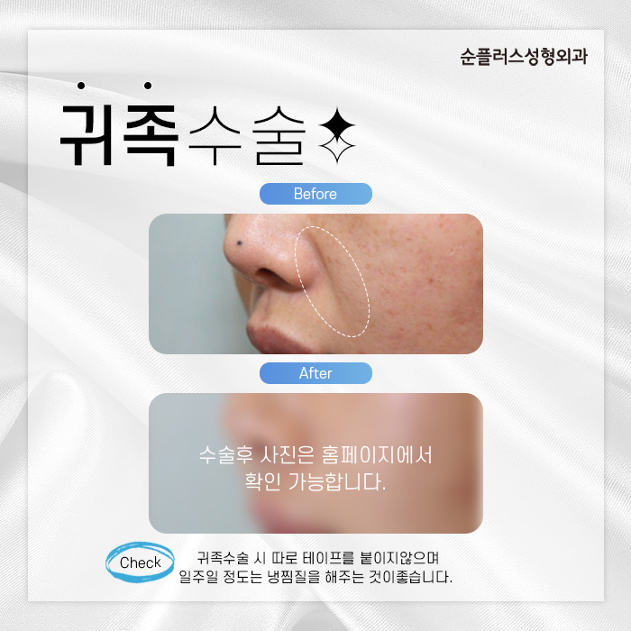 젊은층부터 중년까지 팔자고민엔 귀족수술 관련 이미지 4