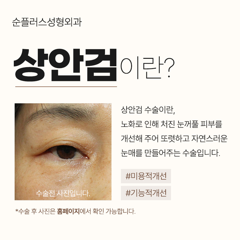 노화로 처진눈꺼풀 자연스러운 쌍꺼풀라인 위해 관련 이미지 2