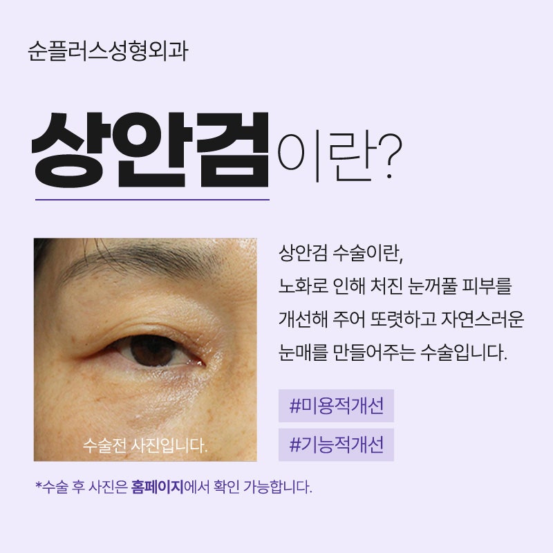 눈처짐으로 인한 중년눈성형 상안검으로 자연스러운 또렷함 추가 관련 이미지 2