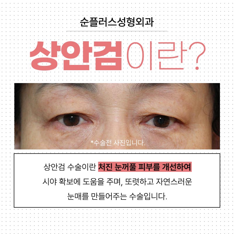 처진눈수술 자연스럽게 또렷해지는 눈매 관련 이미지 2