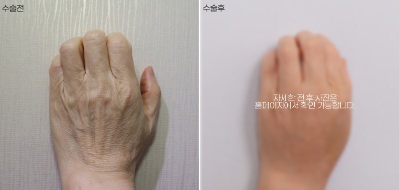 A lively effect for dry, wrinkled backs of the hands with fat grafting image 8