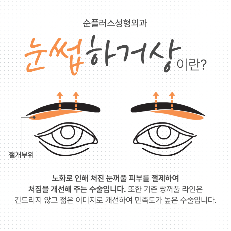 눈꺼풀처짐수술 중년눈꺼풀이 처졌다면 관련 이미지 2