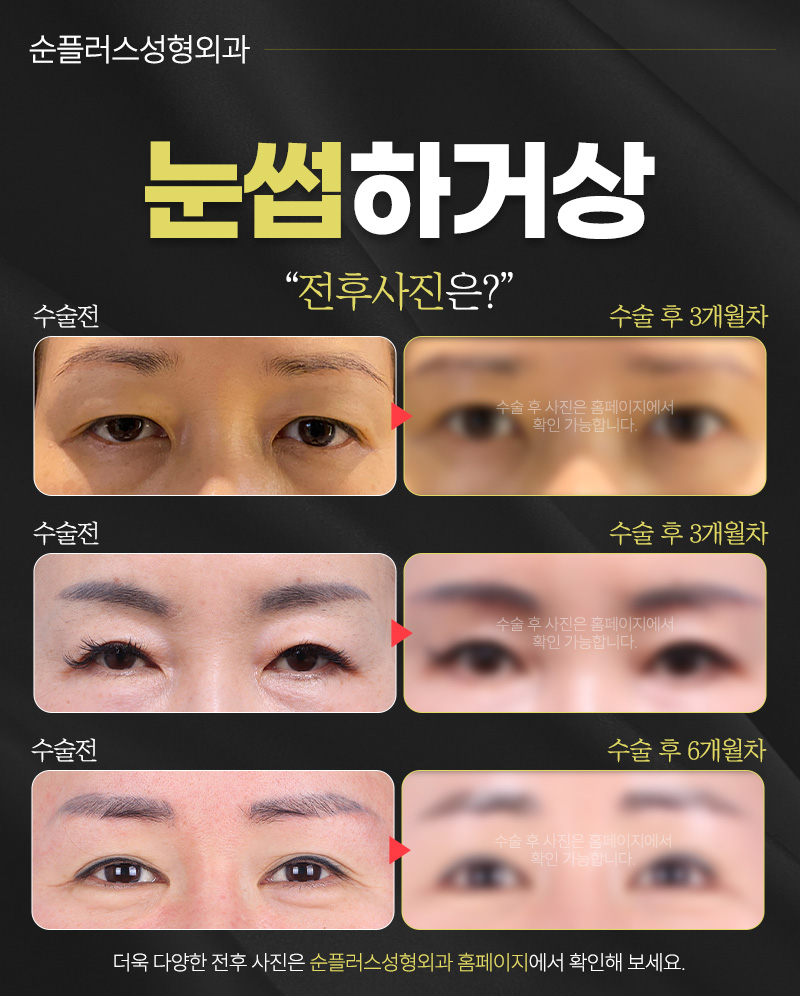 When Aging-Sagging Eyelids Need a Natural Brow Lift [Brow Ptosis Correction] image 6