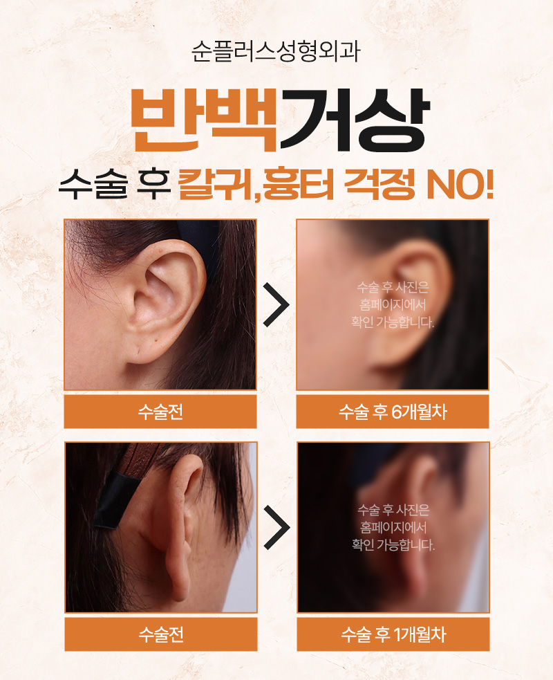 나이들어 보이는 얼굴 반백거상(안면거상)으로 어려질 수 있을까 관련 이미지 5