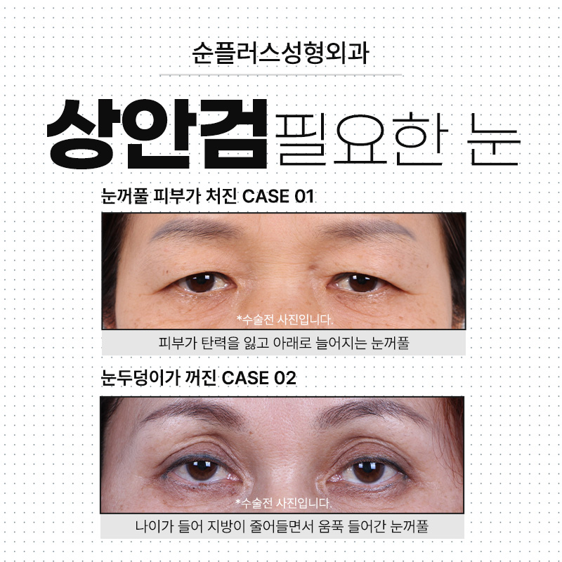 처진눈수술 늘어진 피부 개선으로 선명한 인상과 시야확보까지 관련 이미지 7