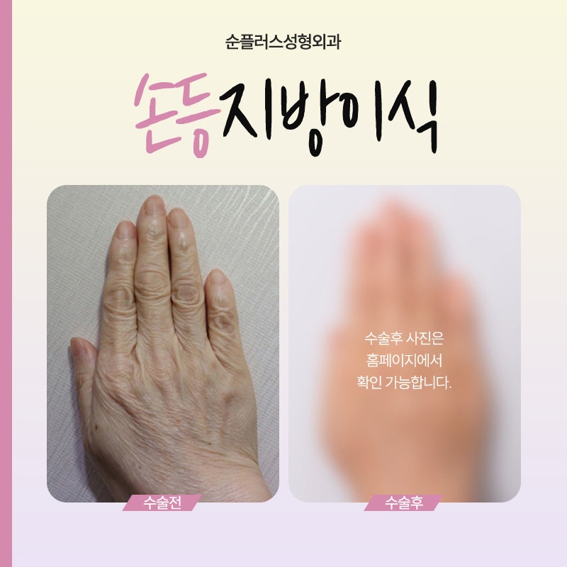 A lively effect for dry, wrinkled backs of the hands with fat grafting image 5