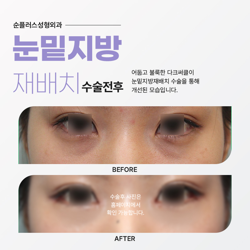 눈밑지방재배치병원 고를때는 신중하게 관련 이미지 5