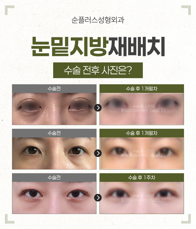 Under-Eye Fat Repositioning Effect - What if Bulging Under-Eye Fat Is Removed? image 5