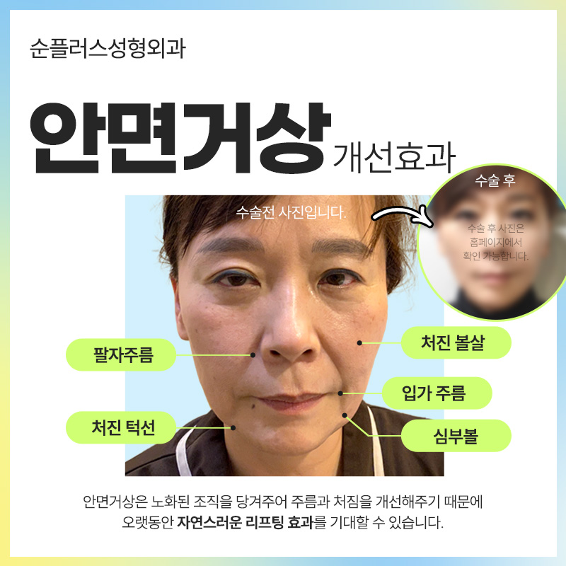 안면거상술잘하는병원 탄력효과를 오래 유지하려면 관련 이미지 6