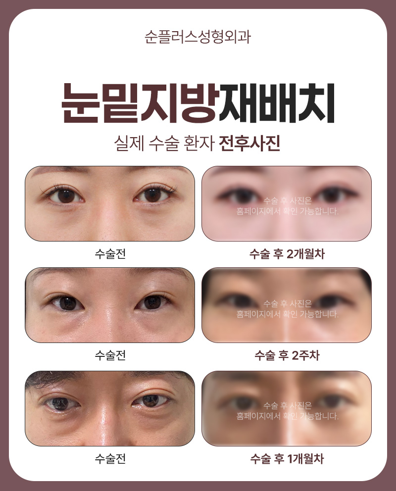 Why Under-Eye Fat Develops and Why Under-Eye Fat Repositioning May Be Needed image 6