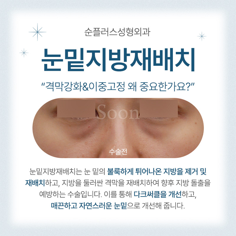 눈밑지방재배치 주의사항 체크와 회복기간 까지 관련 이미지 2