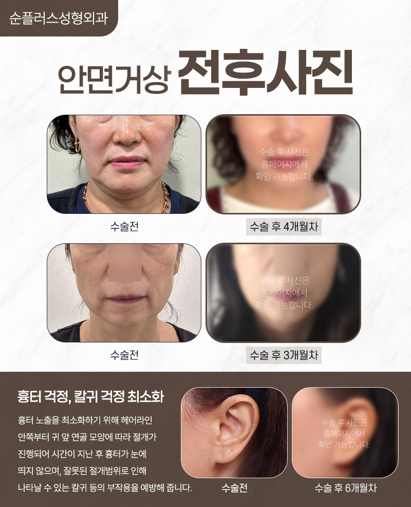 강남안면거상 피부 탄력도를 높이기 위한 관련 이미지 6