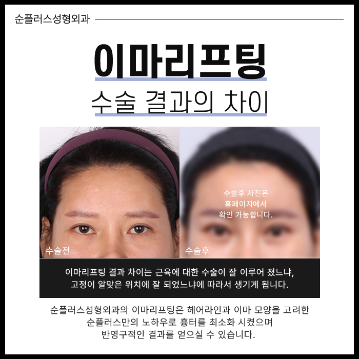 이마리프팅 정교함의 차이로 관련 이미지 6