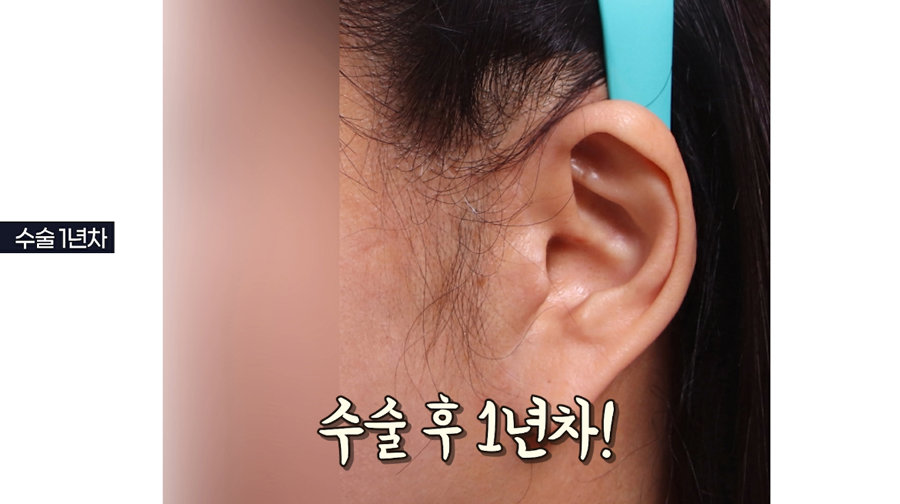 안면거상회복과정, 흉터 아무는 시기 관련 이미지 7