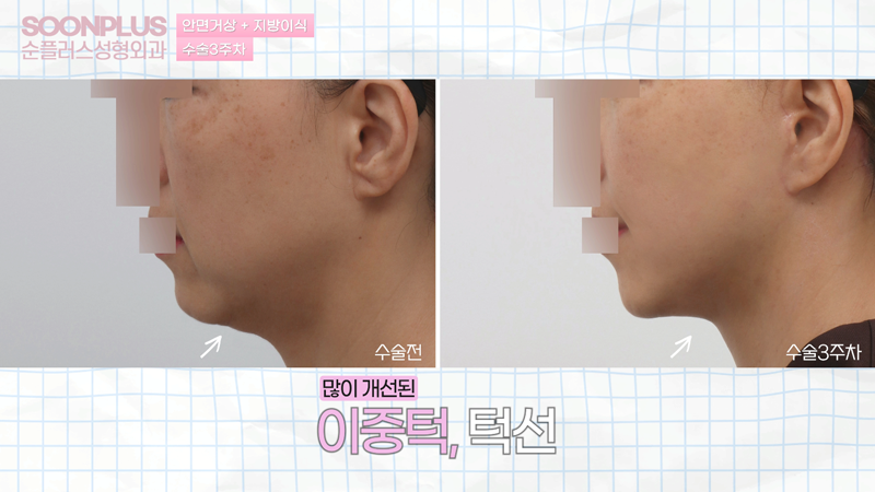 안면거상 지방이식 병행시의 안면거상효과 관련 이미지 3
