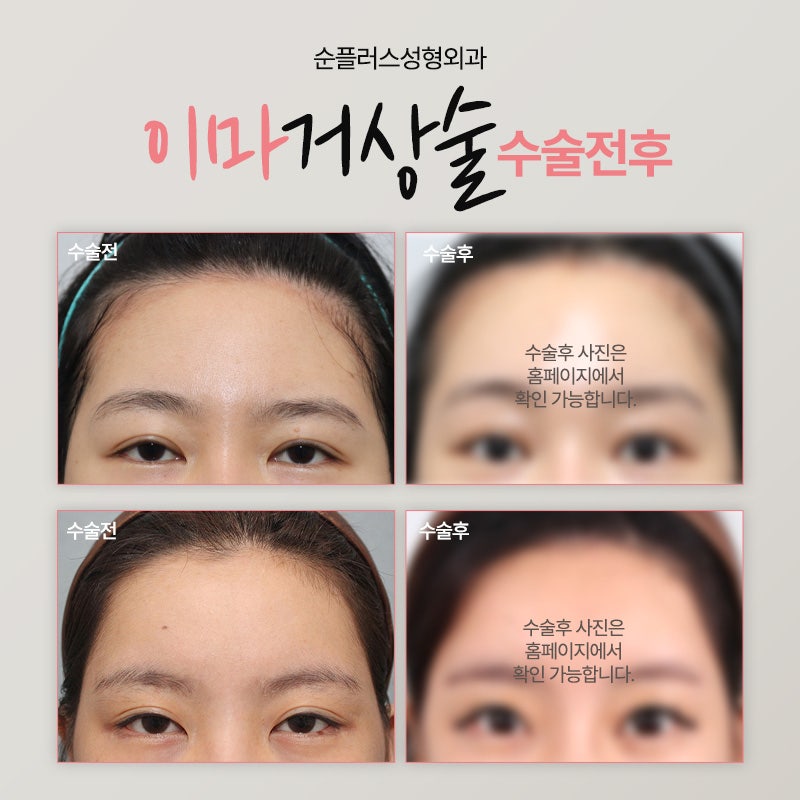 The Right Place for Forehead Lift Surgery After Checking the Symptoms image 5