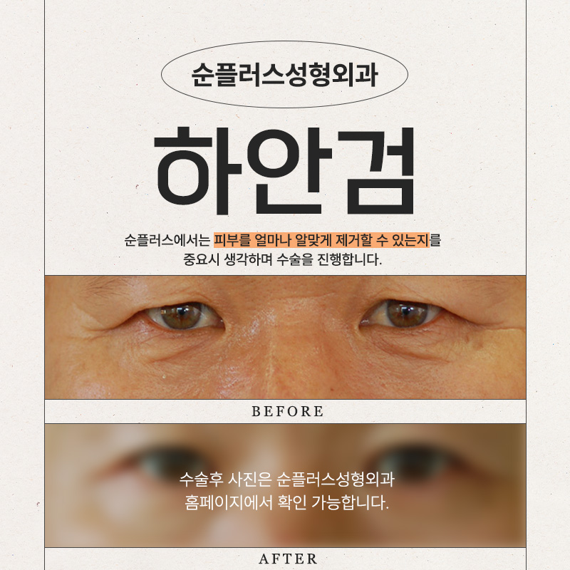 신사역 하안검수술병원 눈밑에 두툼하게 무언가가 생겼다면? 관련 이미지 5