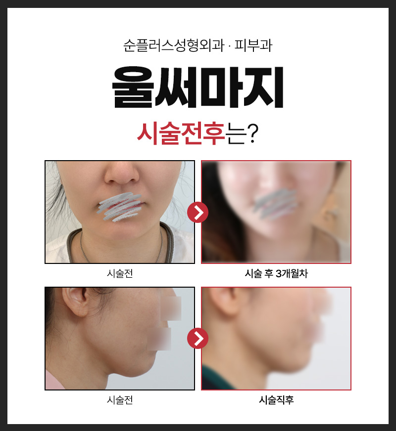 처진 피부에 리프팅 효과와 콜라겐 재생으로 타이트닝 효과를 동시에 울써마지 (울쎄라+써마지) 관련 이미지 5