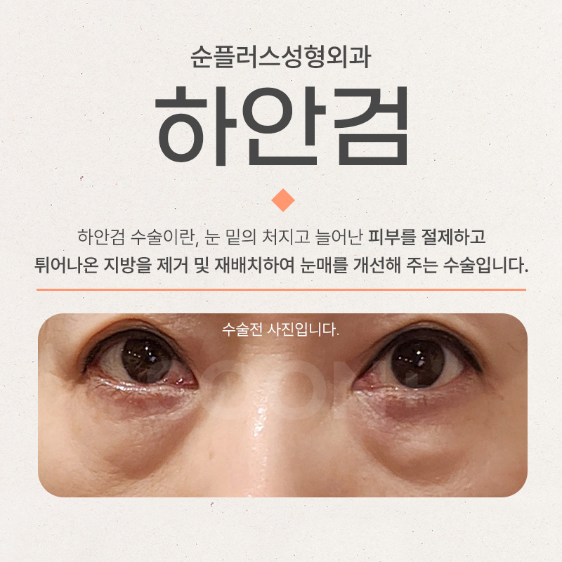 하안검수술회복기간 처짐에 따라 관련 이미지 2