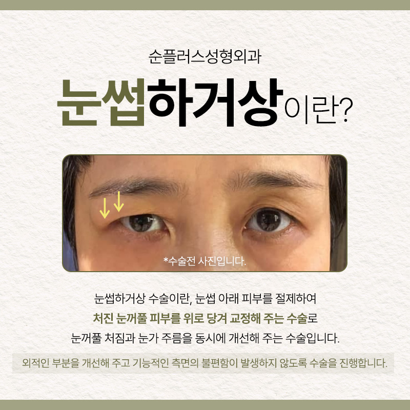 눈과 눈썹사이 거리가 멀고 처진눈꺼풀이 신경쓰인다면 [눈썹거상] 관련 이미지 2