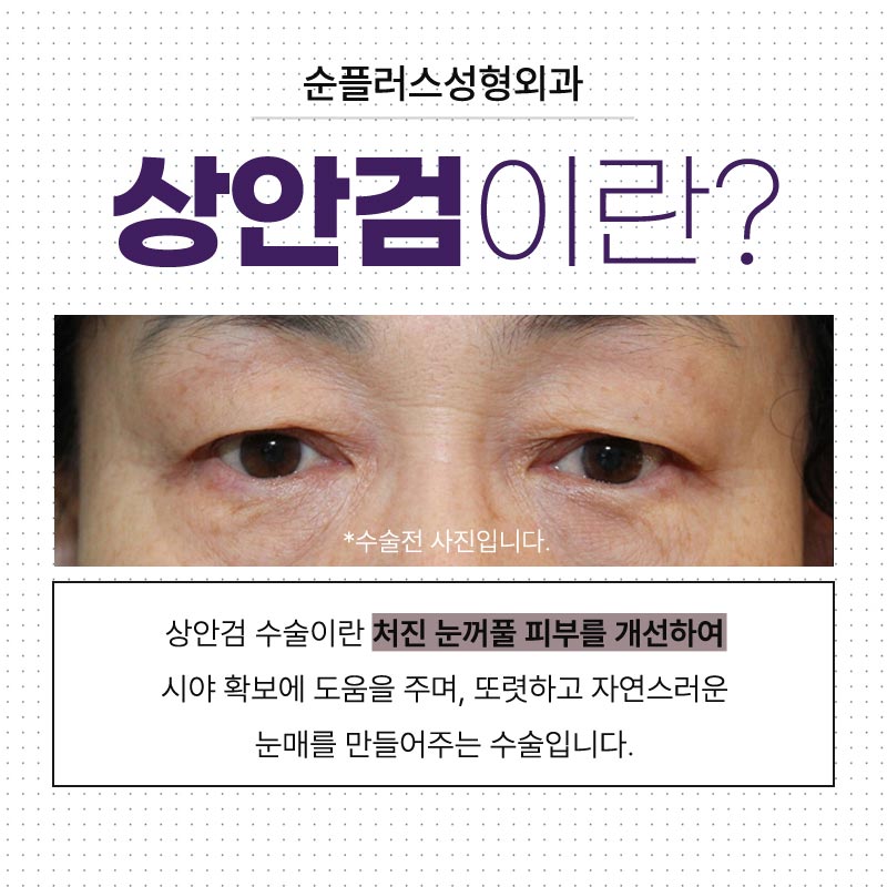 중년쌍꺼풀수술 처짐은 자연스럽게 관련 이미지 2