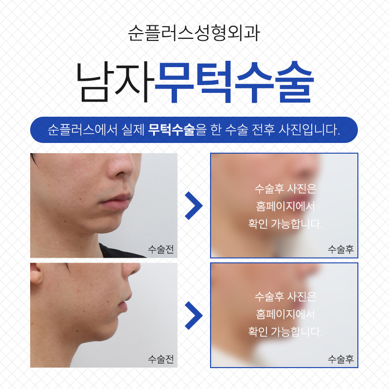 Balancing a Receding Chin to Enhance Attractiveness image 5