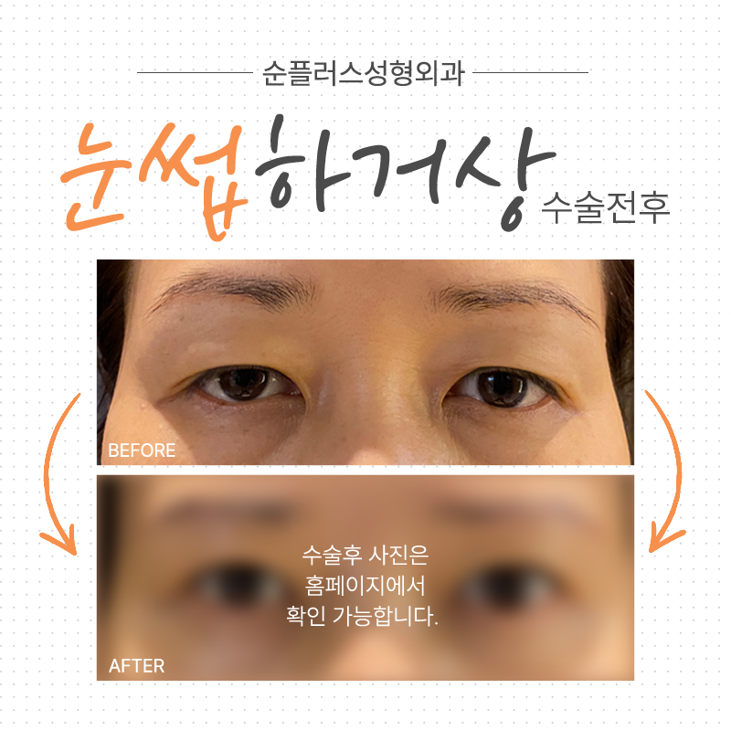 눈꺼풀처짐수술 중년눈꺼풀이 처졌다면 관련 이미지 7