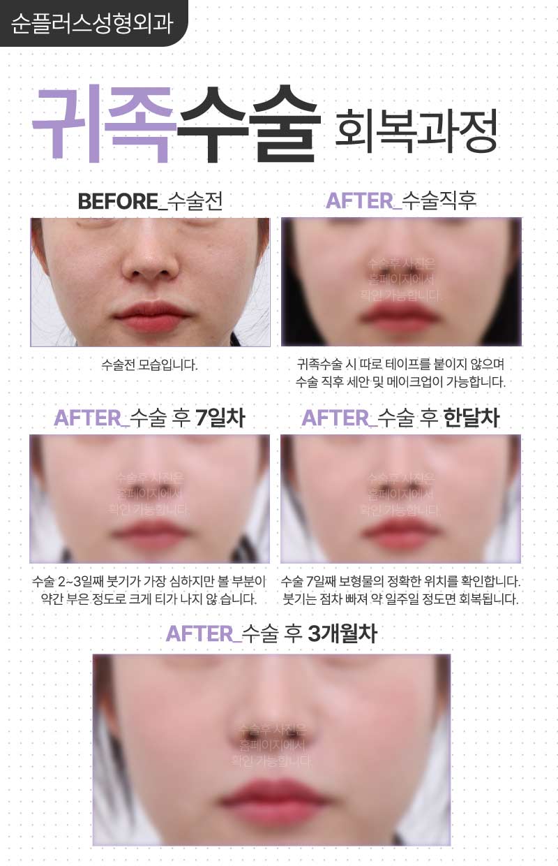팔자주름 돌출입 개선에 보형물 넣는 귀족수술로 효과본다면? 관련 이미지 6