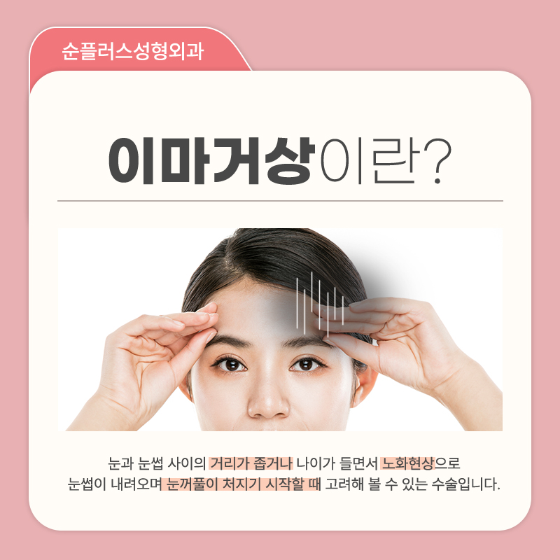 내시경 이마거상술 눈주변 주름개선에도 관련 이미지 2