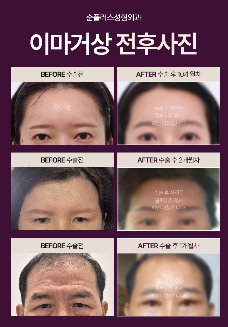 Before and after a forehead lift: what differences in effect might there be? image 3