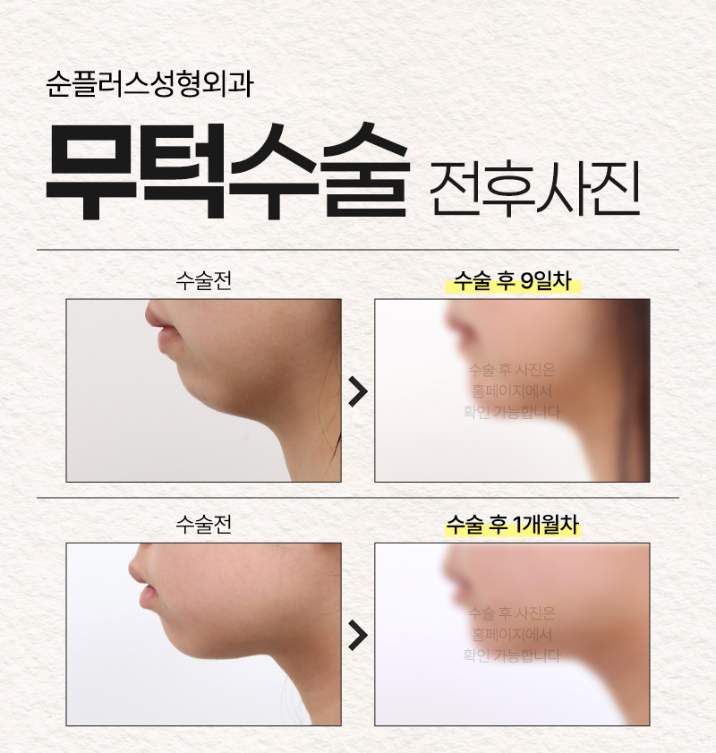If you are considering chin surgery for a small, short recessed chin, achieve balance and proportions with a customized implant image 7