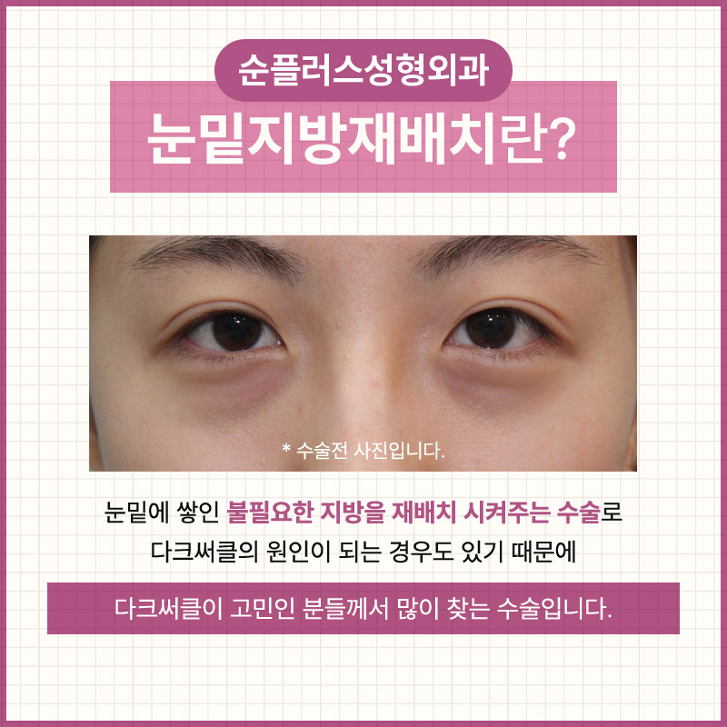 눈밑지방수술 꺼짐과 돌출이 동반되었을때 관련 이미지 3