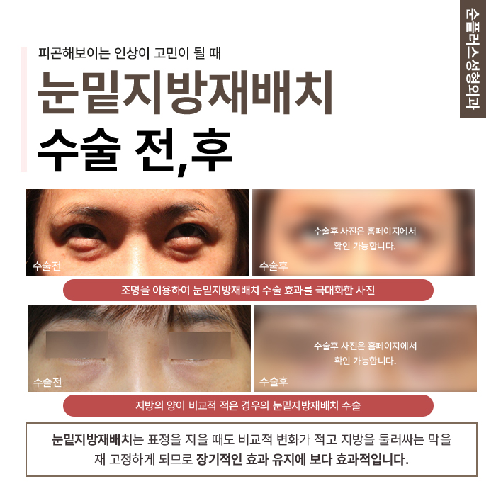 What Makes a Good Under-Eye Fat Repositioning Clinic Different image 4