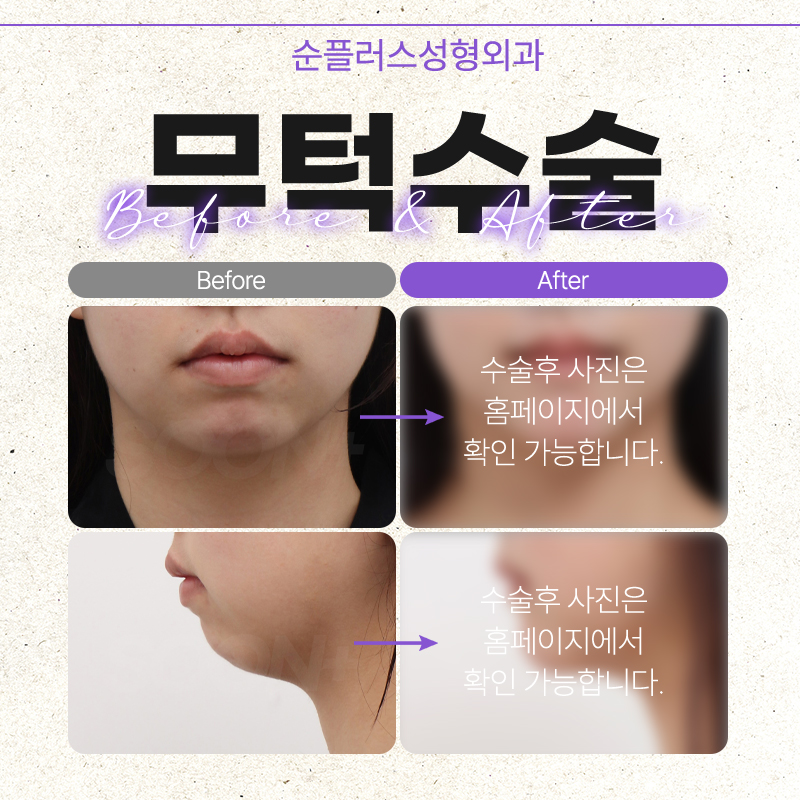 If you’re worried about chin implant movement image 5