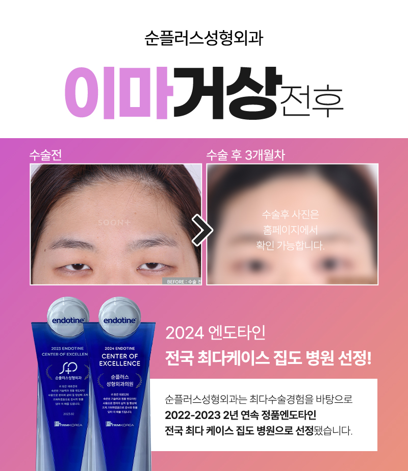 Is forehead lift only recommended for people in their 40s and 50s, and not recommended for people in their 20s and 30s? image 5