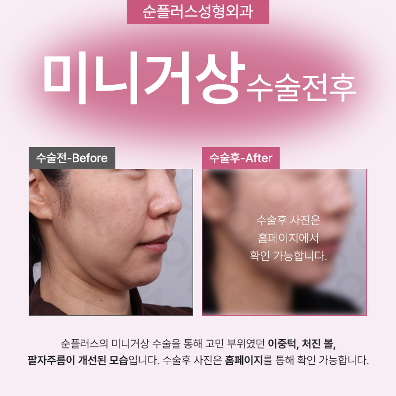 미니안면거상술 심하게 늘어지기 전에 관련 이미지 5