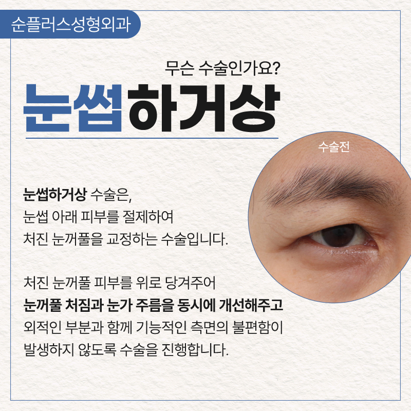 눈과 눈썹사이가 멀고 눈매가 답답해 보인다면 눈썹하거상술로 개선의 기대를 관련 이미지 2