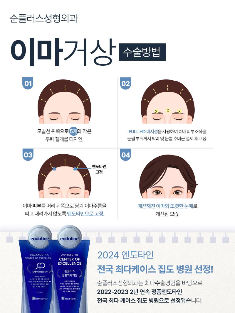 내시경이마거상 잘하는곳 눈성형의 효과까지 관련 이미지 5