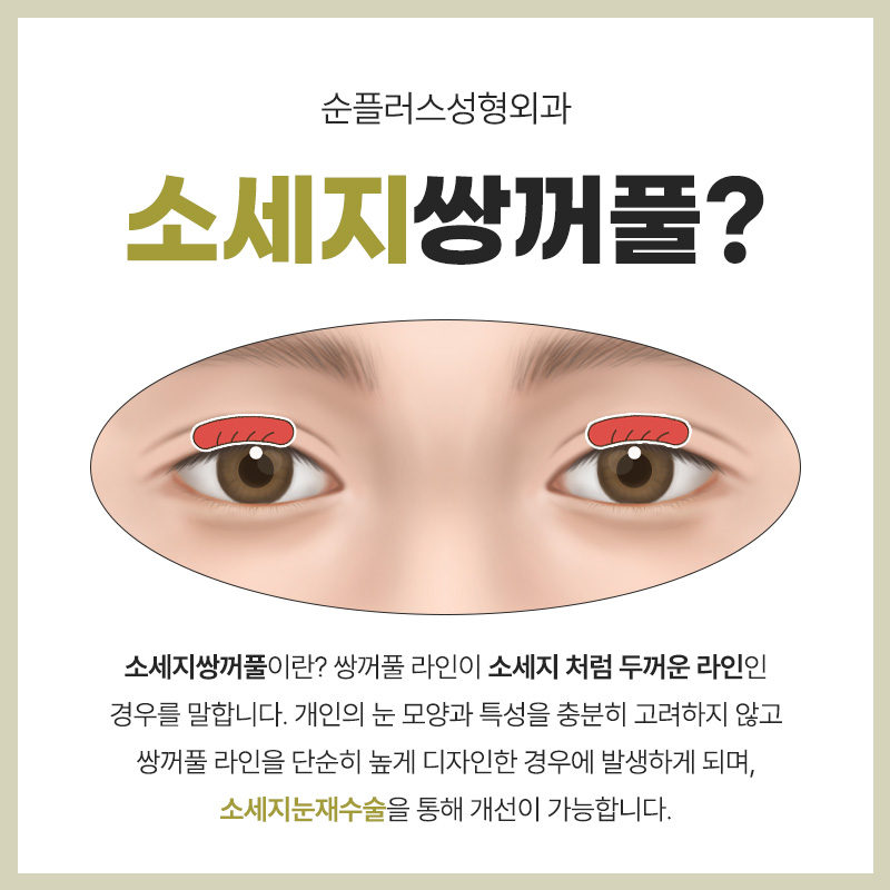 소세지눈재수술 원인 파악하고 그에맞는 플랜으로 관련 이미지 2