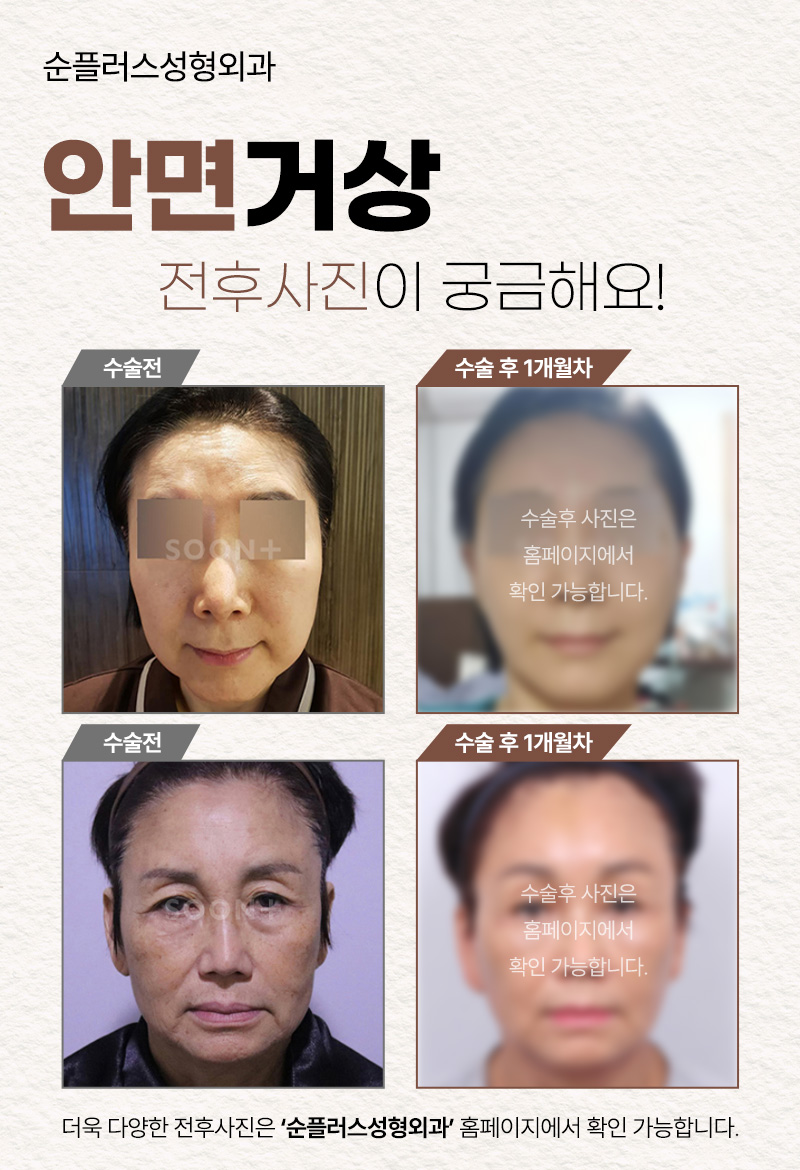 안면거상리프팅 흘러가는 노화를 늦추기위해 관련 이미지 5