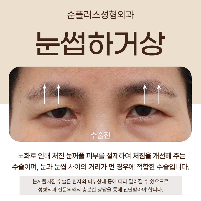 처진눈 자연스럽게 개선하기 위해 눈썹하거상 관련 이미지 2