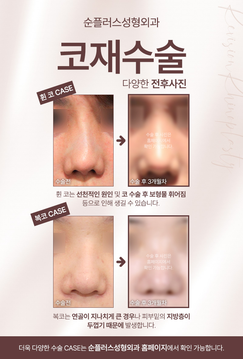 Nose Revision Surgery Clinic: What About Revision Surgery for a Bulbous Nose or Crooked Nose? image 3