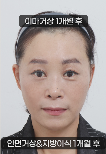 50대 안면거상 이마거상 지방이식으로 동안의 효과를 관련 이미지 3