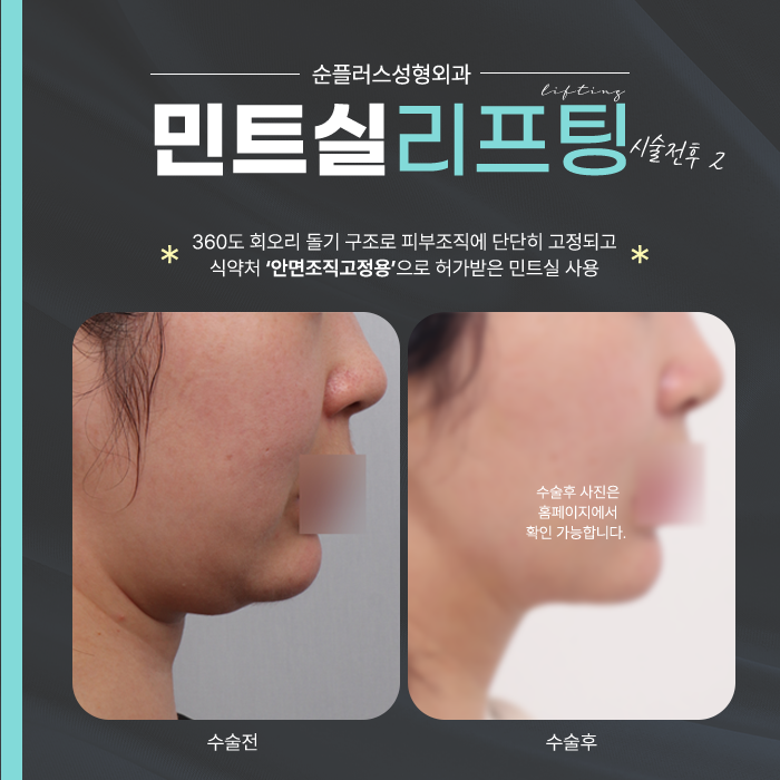 Which Thread Lifting Clinic Should You Choose? image 5
