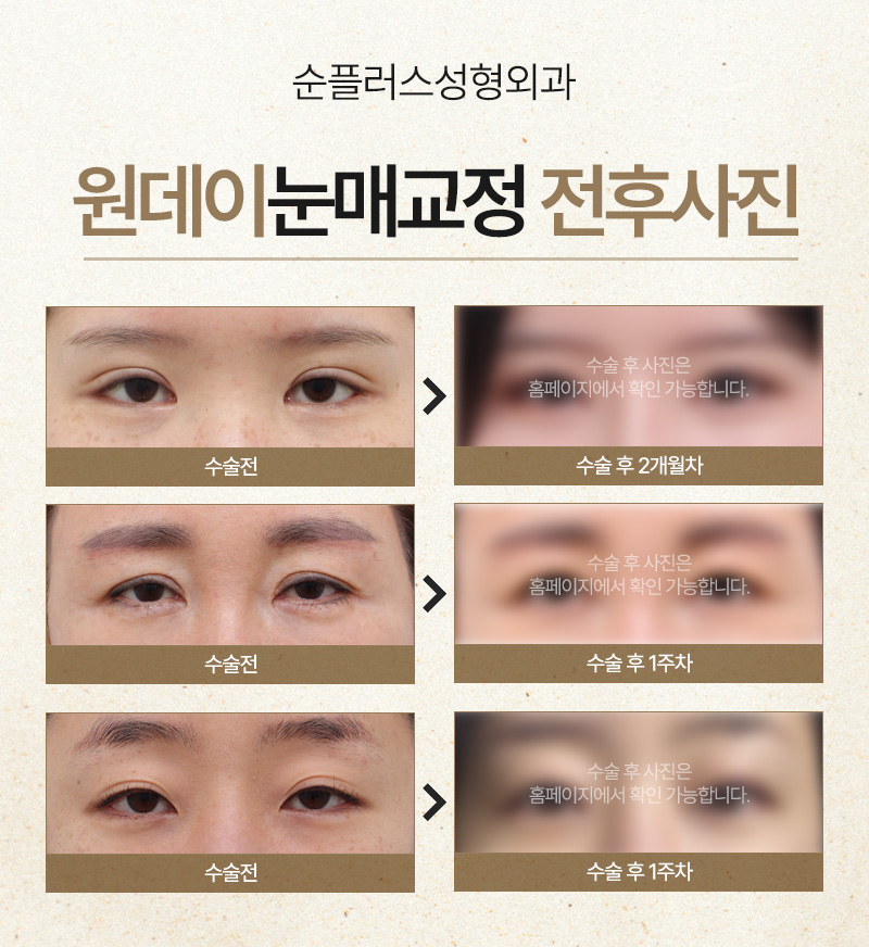 졸린눈 교정, 하루만에 개선된다면? [원데이눈매교정] 관련 이미지 6