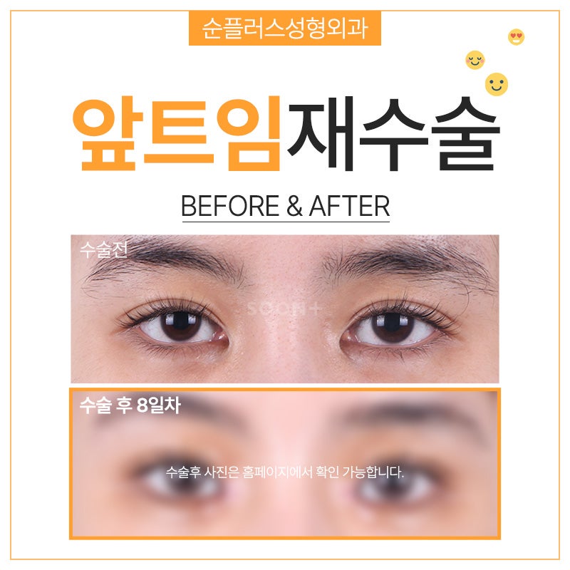 앞트임재수술 복원으로 눈앞머리 자연스럽게 관련 이미지 5