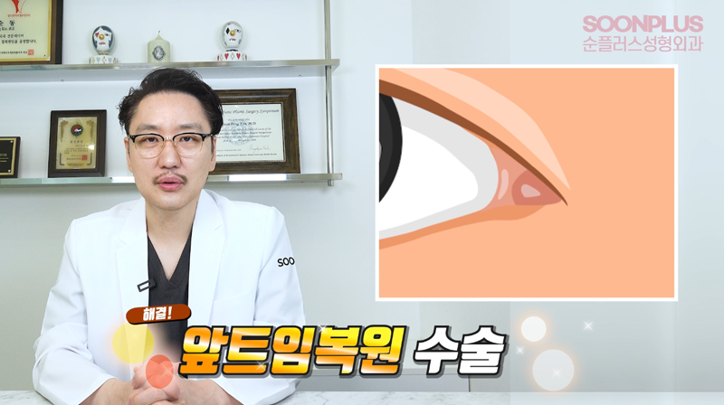 'Am I Really a Candidate for Epicanthoplasty Revision?' Dr. Kim Soondong’s Story About Epicanthoplasty Revision Surgery image 6
