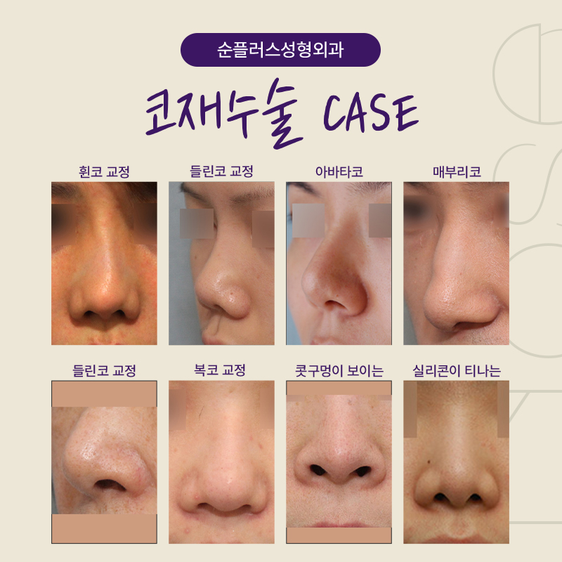 코재수술잘하는곳 신사역에 위치한곳 관련 이미지 4