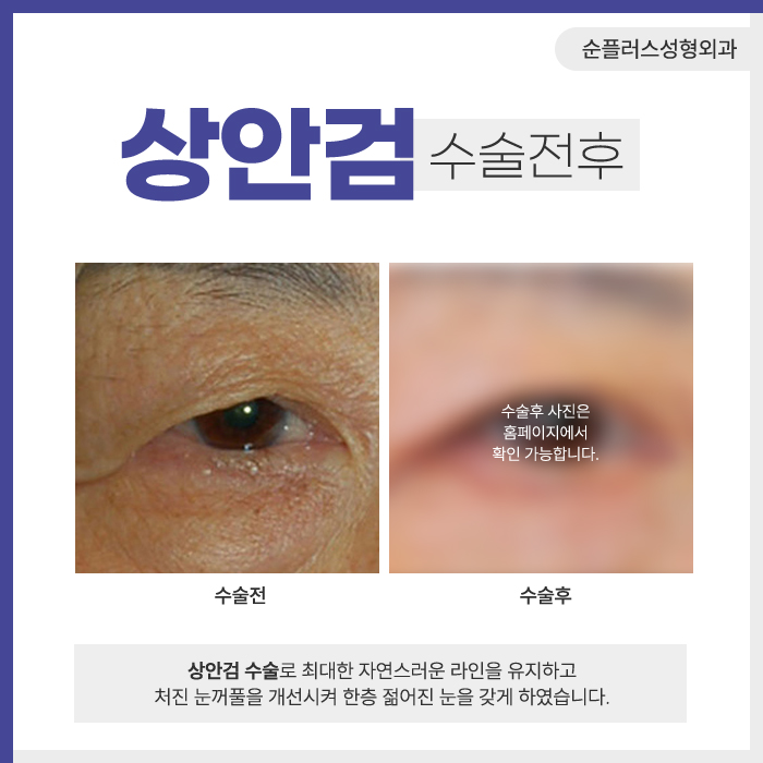 상안검수술 효과 눈꺼풀이 처졌을때 관련 이미지 4